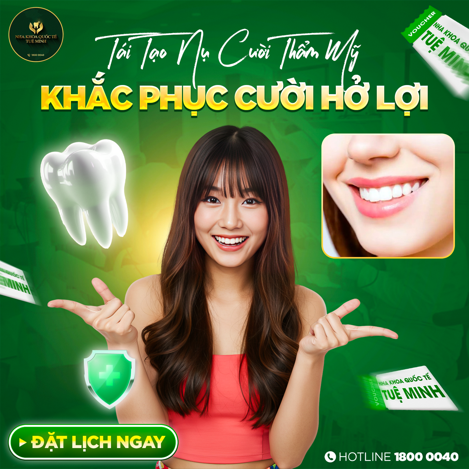 Tái Tạo Nụ Cười Thẩm Mỹ – Khắc Phục Cười Hở Lợi