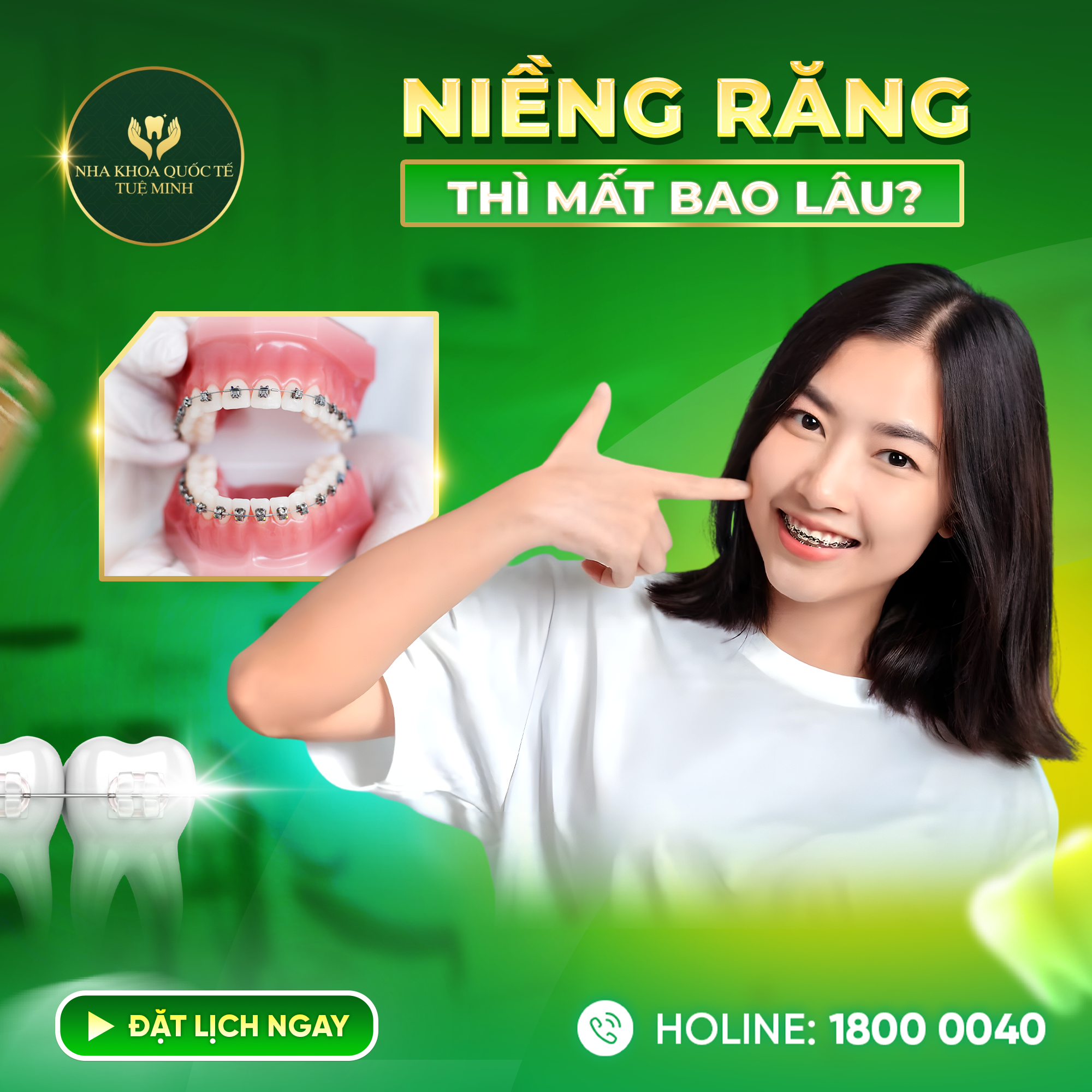 Niềng Răng Thì Mất Bao Lâu?