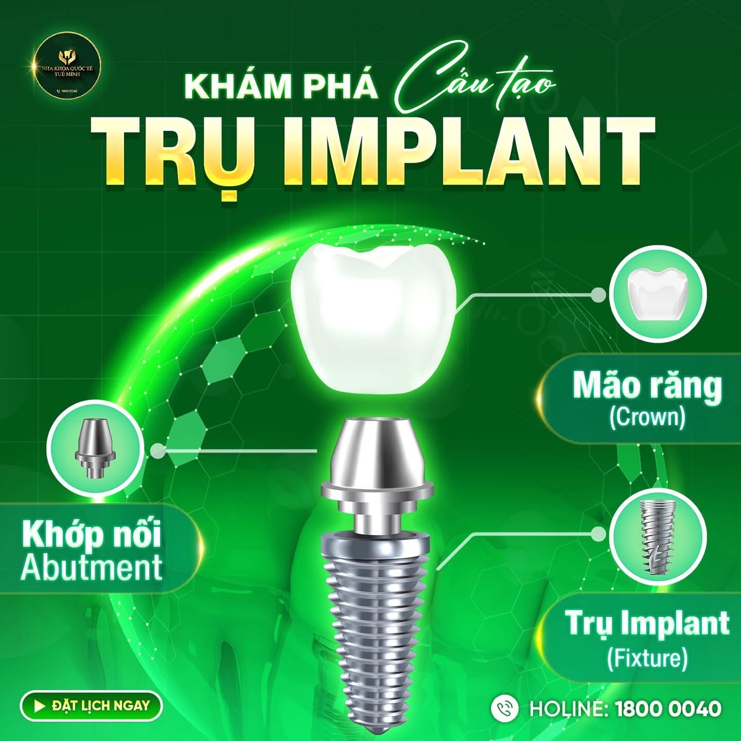 Khám Phá Cấu Tạo Trụ Implant – Nhỏ Nhưng “Có Võ”