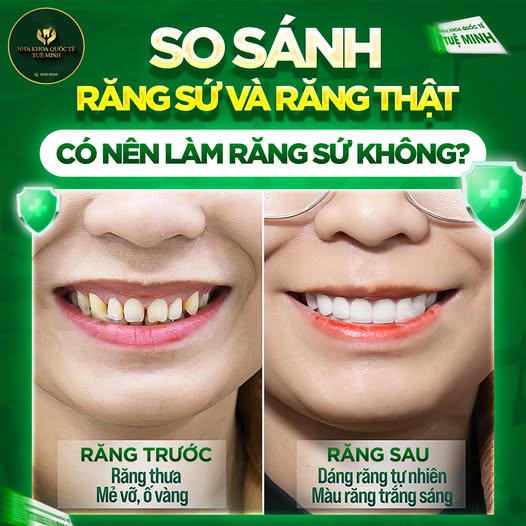 RĂNG SỨ THẨM MỸ: GIẢI PHÁP HOÀN HẢO CHO NỤ CƯỜI ĐẸP TỰ NHIÊN