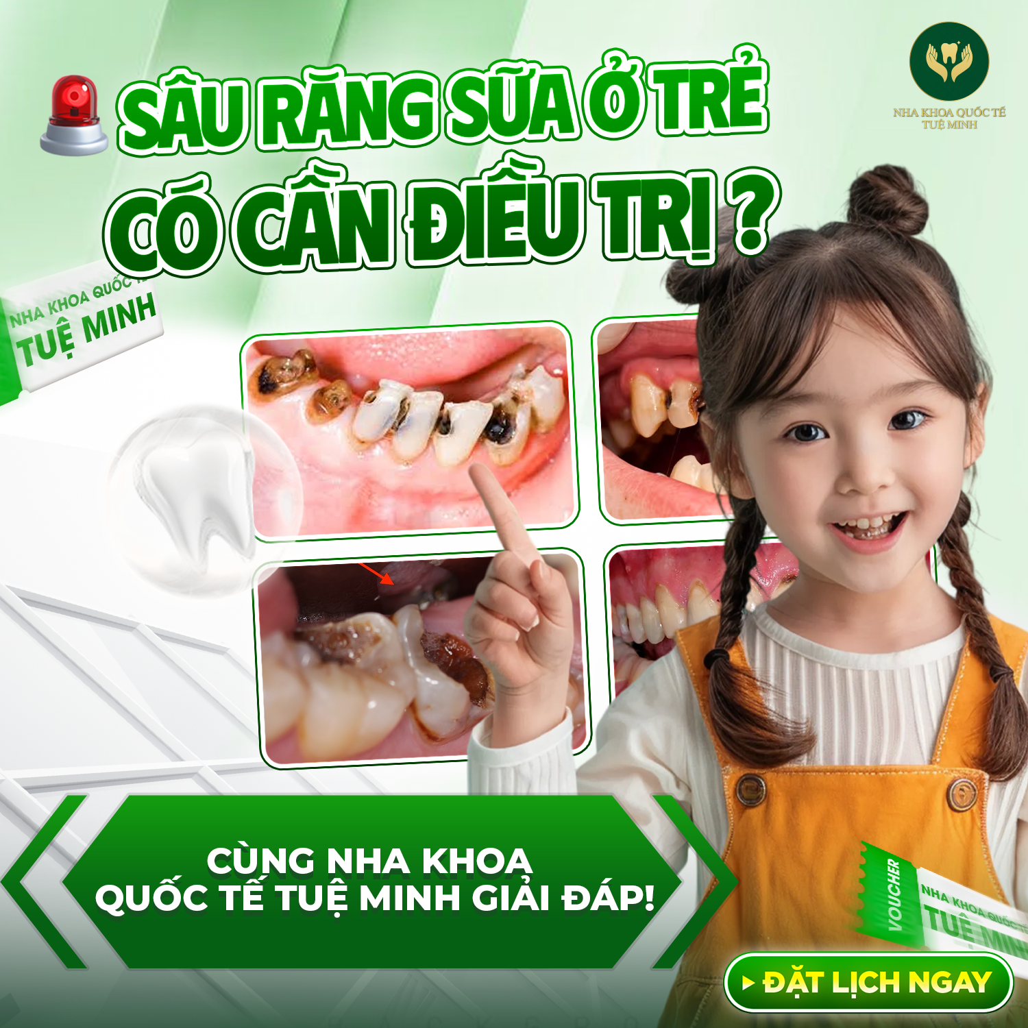 SÂU RĂNG SỮA Ở TRẺ CÓ CẦN ĐIỀU TRỊ?