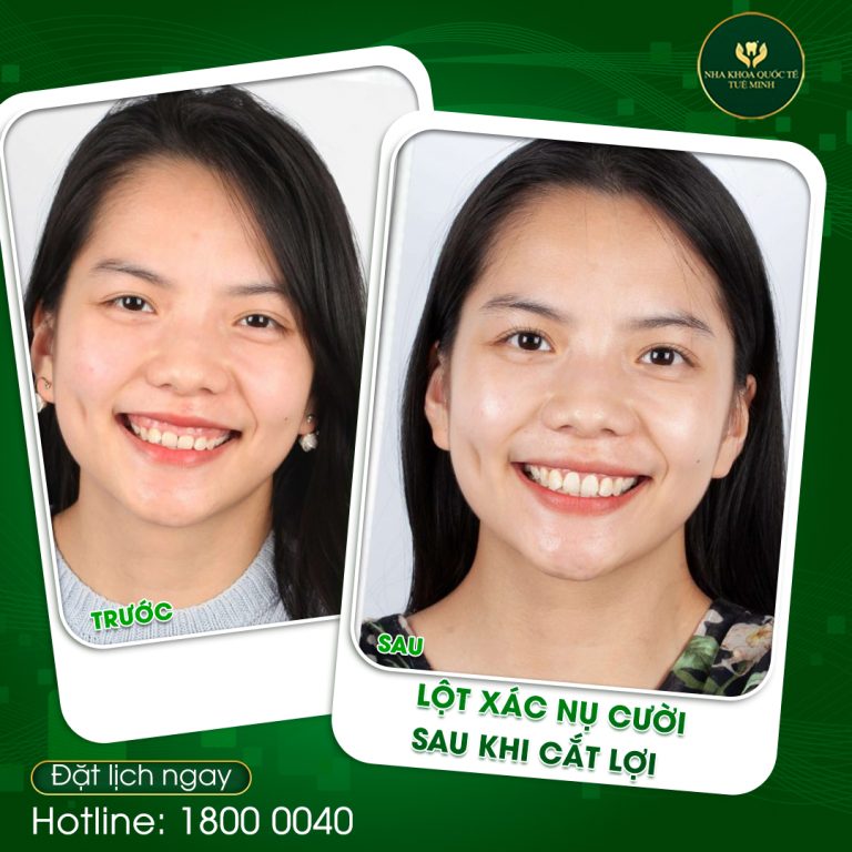 LỘT XÁC NỤ CƯỜI SAU KHI CẮT LỢI