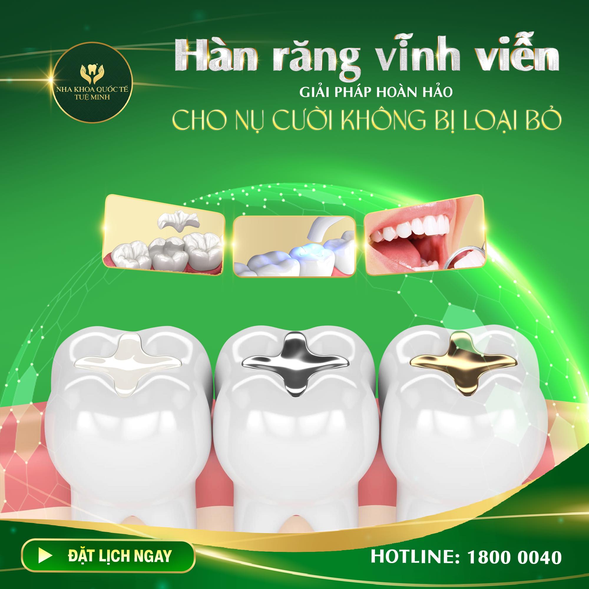 HÀN RĂNG SỮA – DUY TRÌ NỤ CƯỜI TƯƠI TẮN CHO TRẺ TẠI NHA KHOA QUỐC TẾ TUỆ MINH