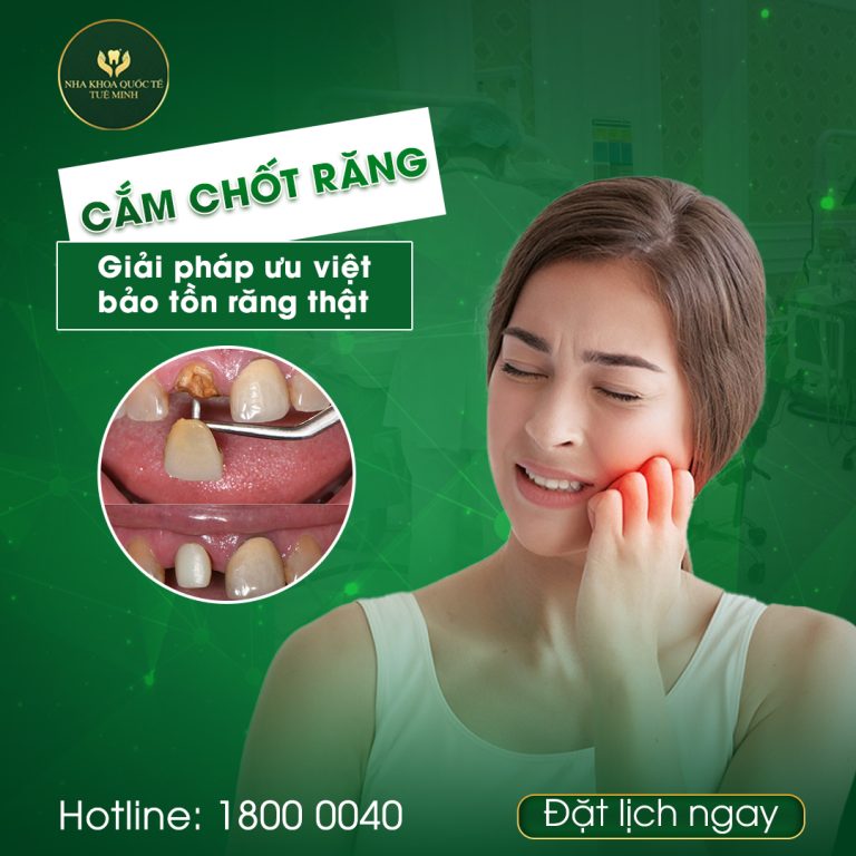 CẮM CHỐT RĂNG TẠI NHA KHOA QUỐC TẾ TUỆ MINH – GIẢI PHÁP CHO RĂNG LỎNG, MẤT ĐỘ BỀN!